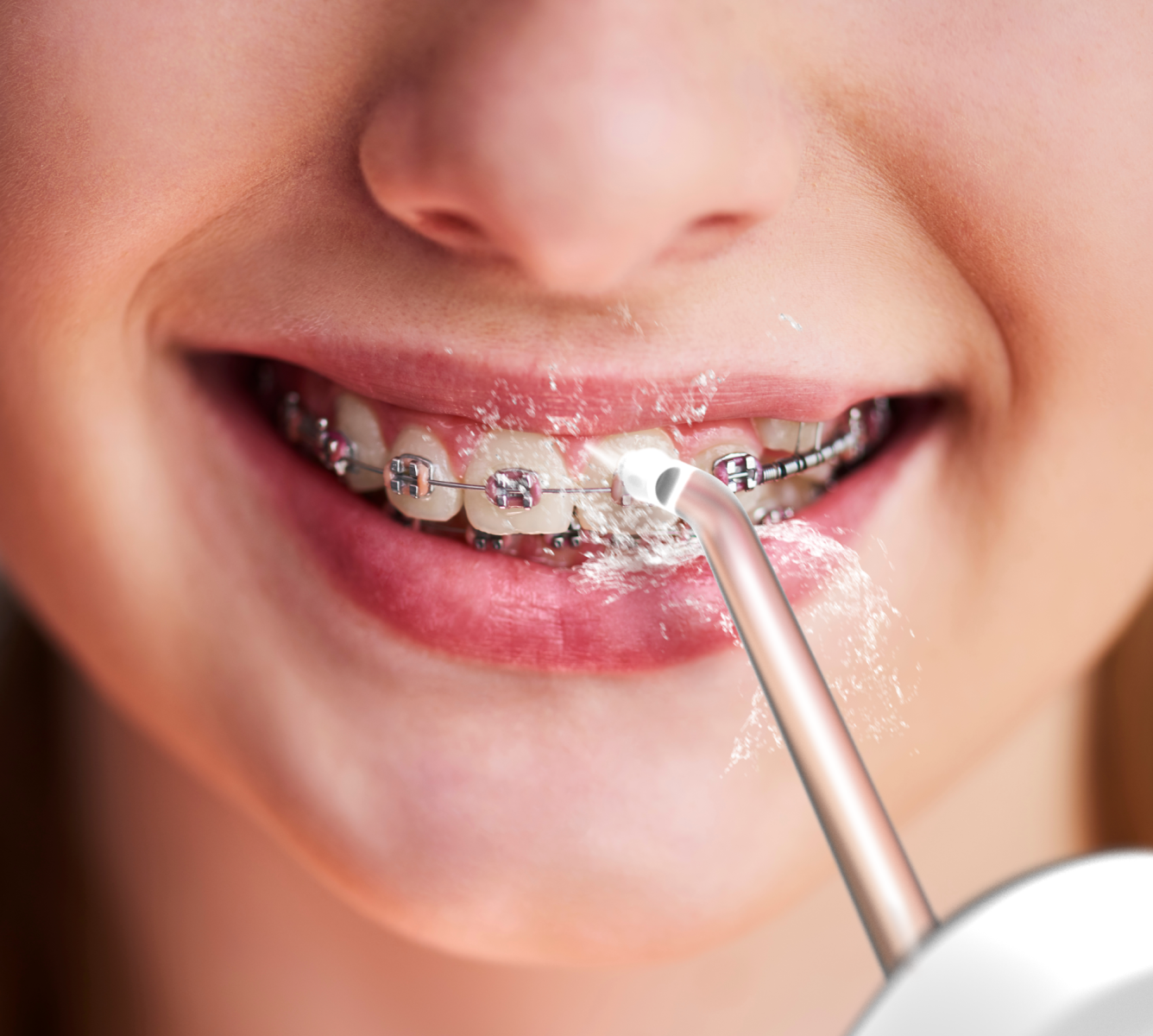 Perfect pentru curățarea aparatelor dentare